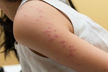 Photo of bedbug bite