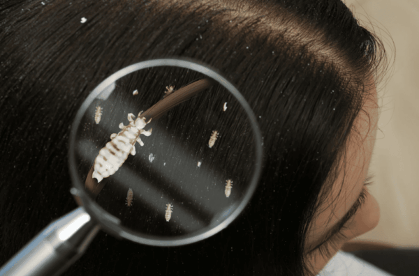 Head lice or nits: how to tell them apart (with photos)- Sereni-d®